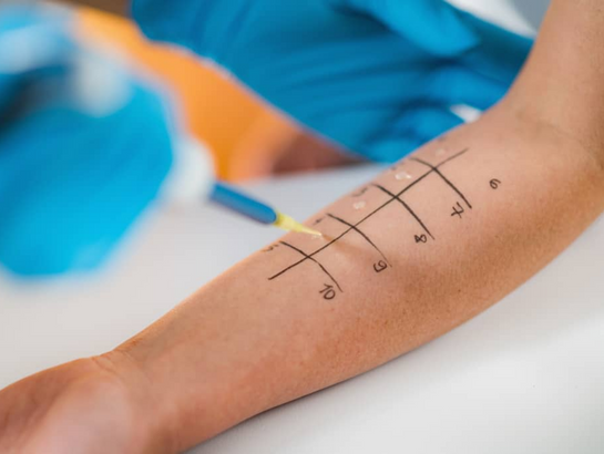 skin-prick-test-near-kondapur