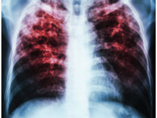 tuberculosis-near-kondapur